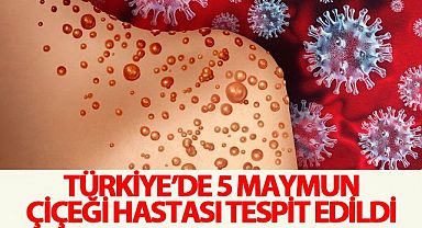 Bakan Koca: Türkiye'de 5 maymun çiçeği hastası tespit edildi