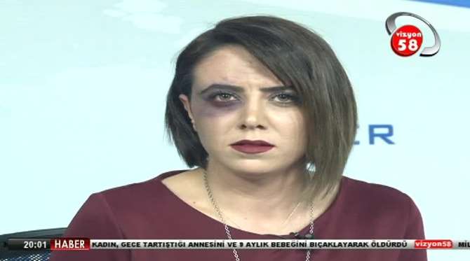 Canlı Yayına Morarmış Gözle Çıktı