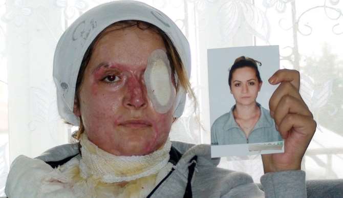 Kocasının Kezzapla Bu Hale Getirdiği Kadın Yardım Bekliyor